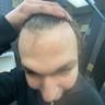Cooked Hairline💀