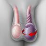 Testicular Torsion